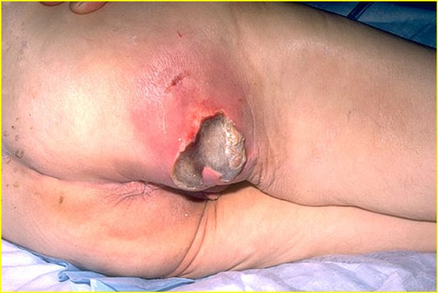 Gross clinical or pathological specimen illustrating the ulcerative pattern of inflammation.