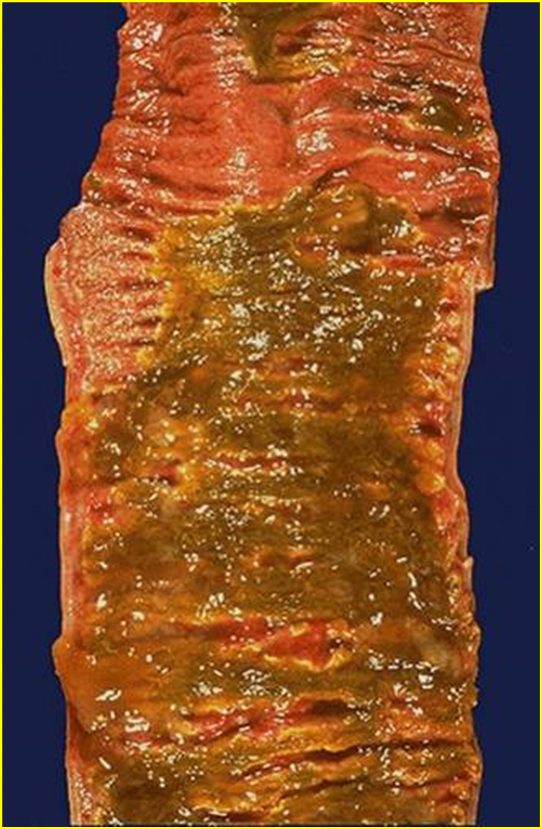 Gross clinical or pathological specimen illustrating the pseudomembranous pattern of inflammation.