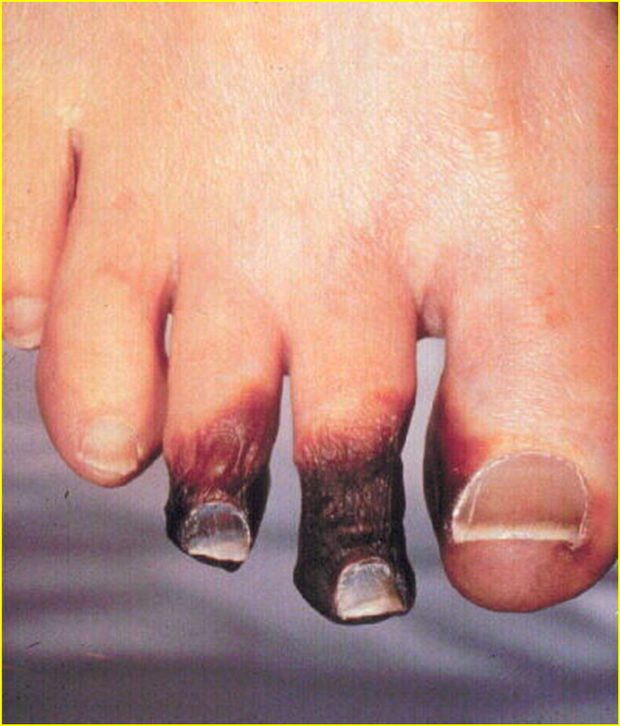 Gross clinical or pathological specimen illustrating the gangrenous (dry) pattern of inflammation.