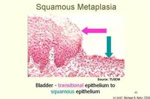 Histology slide labeled Squamous Metaplasia, with arrows marking bladder transitional epithelium on one side changing to squamous epithelium on the other.