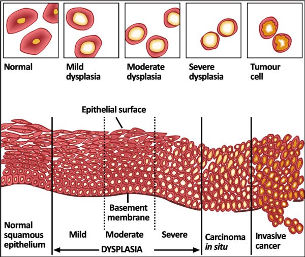 Diagram of squamous epithelium across a spectrum, labeled normal, mild, moderate and severe dysplasia, then carcinoma in situ, then invasive cancer, with the basement membrane drawn as a line that only the invasive cancer crosses.