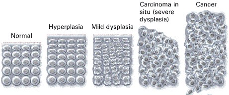 Diagram of cell populations labeled normal, hyperplasia, mild dysplasia, carcinoma in situ described as severe dysplasia, and cancer, with the cells becoming progressively more disordered.