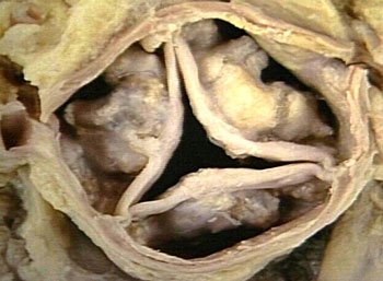 Gross specimen of an aortic valve with three cusps filled with heaped-up nodular calcium.