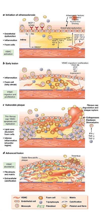 Three-panel diagram: initiation of atherosclerosis, early lesion, and vulnerable plaque, with labeled cells and mediators.