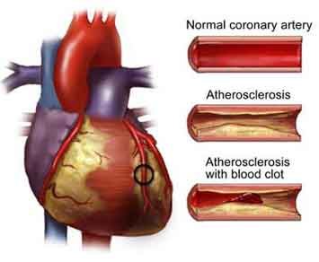 Heart with a circled region of damaged muscle beside three coronary artery sections: normal, atherosclerosis, and atherosclerosis with blood clot.