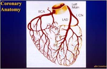 Schematic of coronary anatomy labeled right coronary artery, left main, left anterior descending and left circumflex.