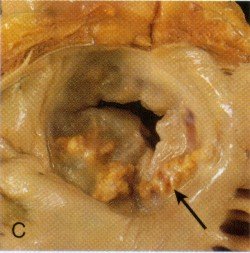 Gross specimen of a stenotic mitral valve seen from above, with an arrow pointing to nodular deposits on the leaflets.