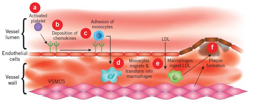 Diagram of a vessel wall with lettered steps a to f from activated platelet to plaque formation.