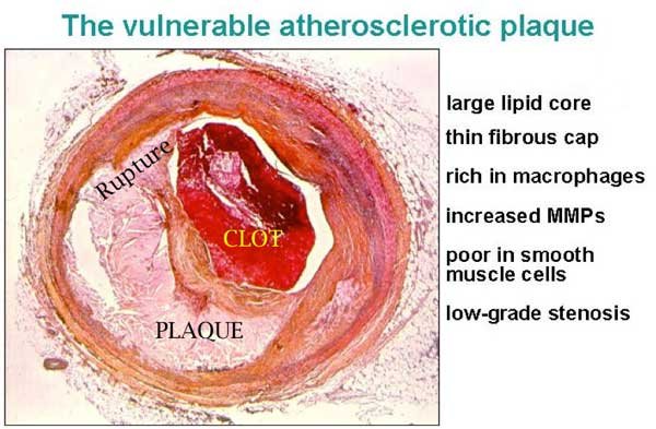 Histologic cross-section of a coronary artery with a ruptured plaque and clot, beside a list of vulnerable plaque features.