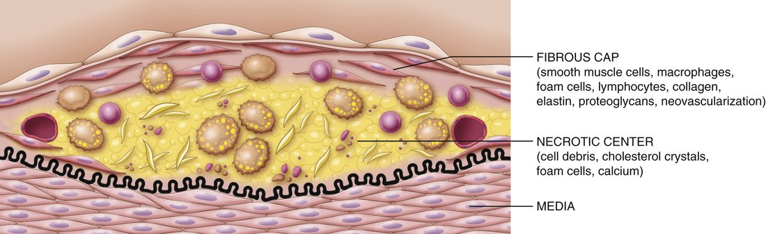 Diagram of an atheroma in the intima: a fibrous cap over a yellow necrotic center, above the media.