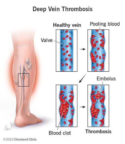 Illustration of a leg with a deep vein, and a sequence of panels: healthy vein with valve, pooling blood, blood clot, embolus.