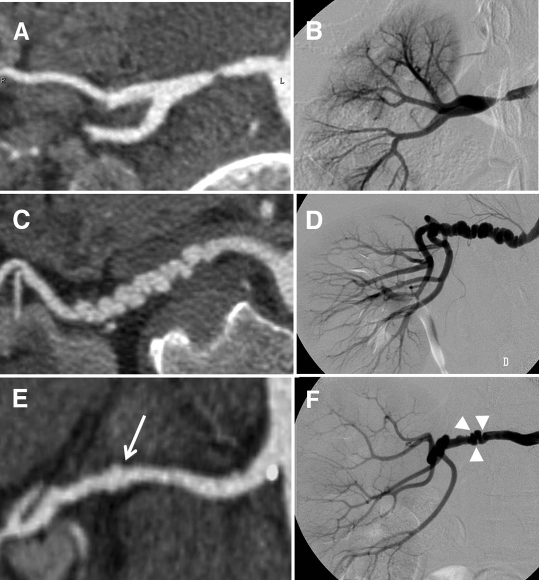 Six panels of computed tomography and catheter angiography images of renal arteries with beaded and focal narrowing.