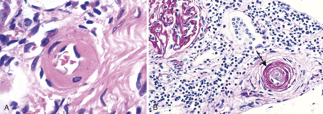 Two micrographs: A, an arteriole with a thick pink glassy wall and narrow lumen; B, an arteriole with concentric onion-skin layers.