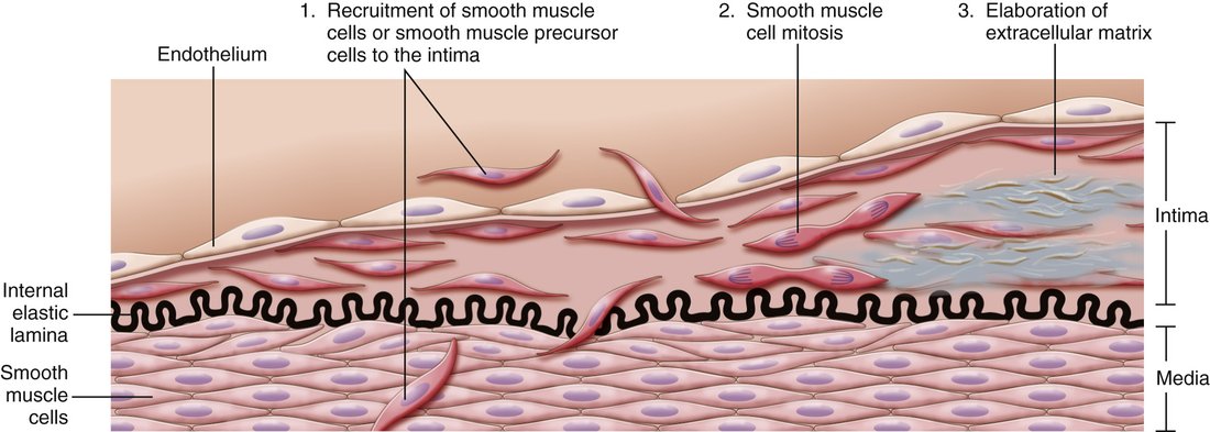 Diagram of a vessel wall showing smooth muscle cells crossing the internal elastic lamina into the intima, dividing, and laying down extracellular matrix.