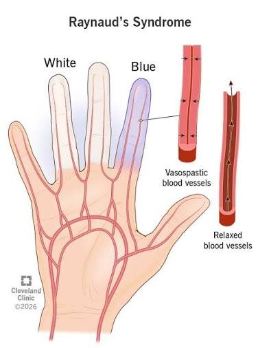Illustration of a hand with a white finger and a blue finger, and insets of vasospastic and relaxed blood vessels.