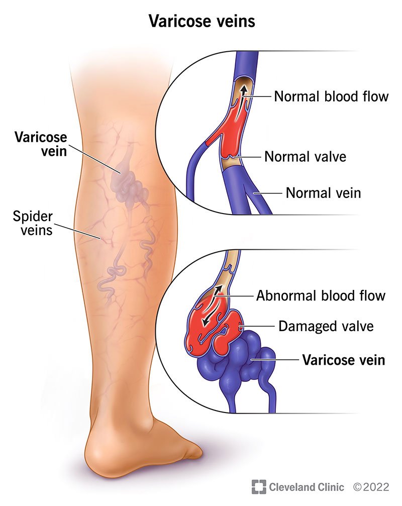 Illustration of a leg with varicose and spider veins, and insets comparing a normal vein and valve with a damaged valve and a varicose vein.