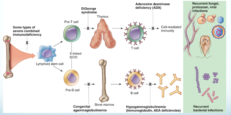 Diagram of lymphocyte development from lymphoid stem cell into T cells via the thymus and B cells via bone marrow, with X marks at the defects: severe combined immunodeficiency, DiGeorge syndrome, adenosine deaminase deficiency, congenital agammaglobulinemia and hypogammaglobulinemia, and the infections each causes.