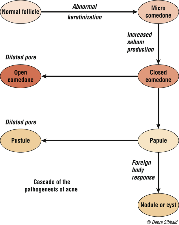 Flow diagram of acne pathogenesis: a normal follicle undergoes abnormal keratinization to a microcomedone, then with increased sebum production to a closed comedone, which either opens into an open comedone or progresses to a papule, then a pustule, and through a foreign body response to a nodule or cyst.