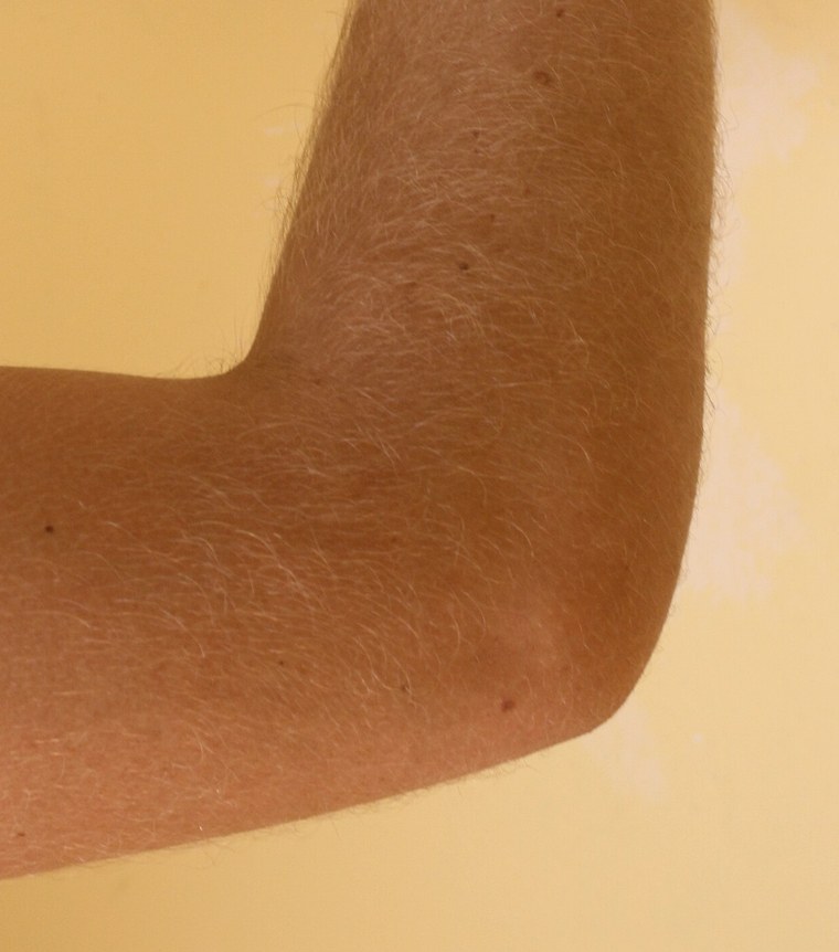 The flexed elbow, as you see it — palpation landmarks marked on a posterolateral view — elbow flexed