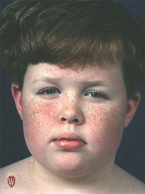 Face of a young child with numerous small light-brown flat spots scattered across both cheeks and the bridge of the nose.