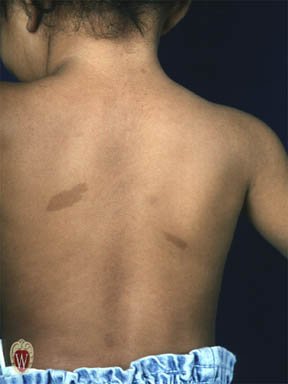 Back of a young child with two flat light-brown areas of uniform color, one on the left mid-back and a smaller one to the right of the spine.