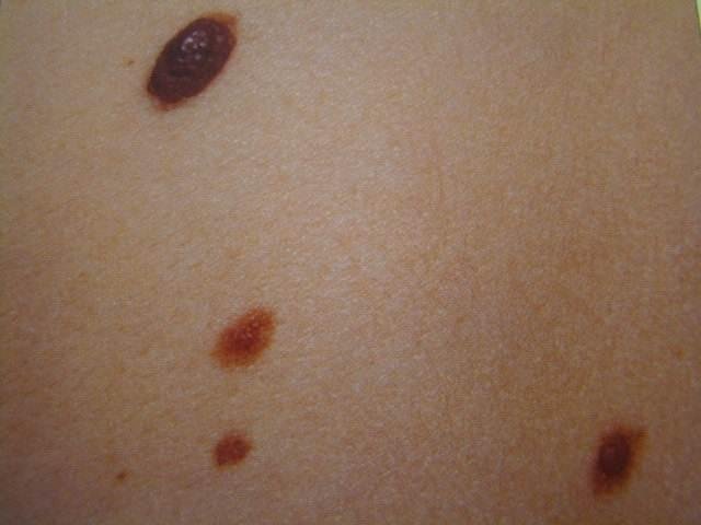 Close view of pale skin with four raised brown lesions of varying size, the largest oval and darkly pigmented, each standing above the surrounding surface.
