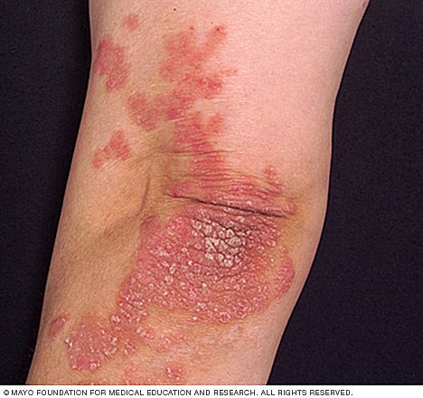 Elbow and forearm with several sharply demarcated raised red areas, the largest flat-topped and covered in thick silvery scale.