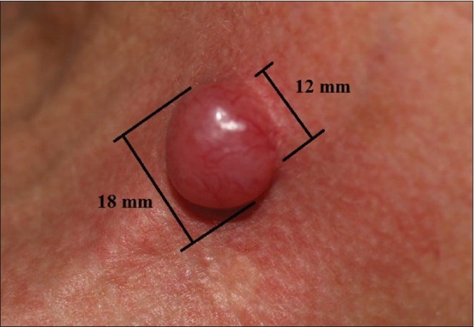 A smooth dome-shaped pink lesion on skin with black measurement bars marking it as eighteen millimeters across and twelve millimeters high.