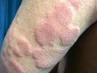 Forearm with several raised pale pink irregular swellings that run together, surrounded by a broader area of redness.