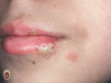 Lower lip and adjacent skin with a cluster of small clear fluid-filled blisters, some crusting, on a red base.