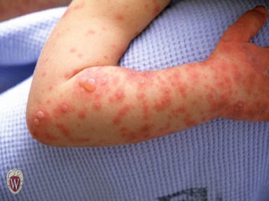 Child's arm covered in numerous raised round fluid-filled blisters of varying size on reddened skin.