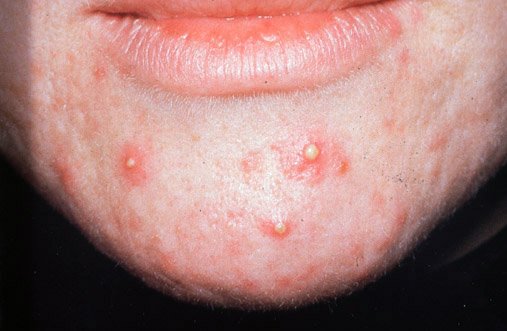 Chin and lower face with multiple small raised lesions, several topped with visible yellow-white material, on reddened skin.