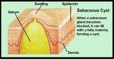Labeled cutaway diagram of a sebaceous cyst showing a large yellow sac of sebum sitting within the dermis and pushing the epidermis upward into a swelling.