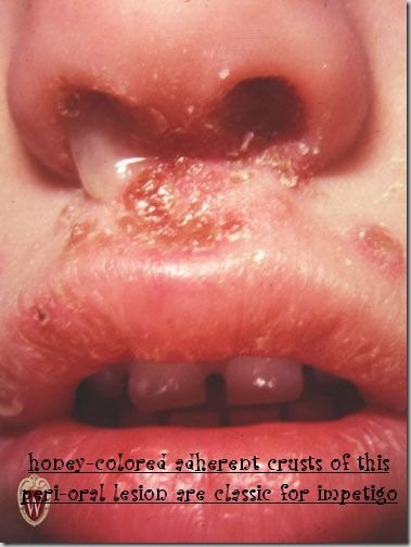 Skin around the nose and upper lip covered with thick golden-yellow adherent crusts over reddened skin.