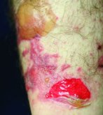 Lower leg with a bright red moist shallow denuded area alongside intact blistered skin and surrounding redness.