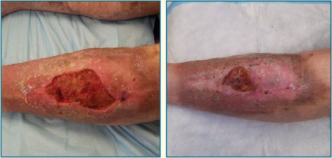 Two photographs of the same lower leg side by side, each showing a deep open wound with a red base and irregular margins, the right panel smaller and healing.