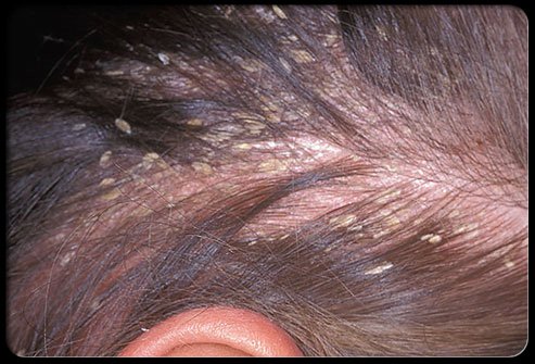 Parted hair revealing scalp scattered with numerous small yellowish-white flakes adherent to the hair shafts and skin.