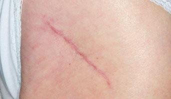 A thin pink linear scar running diagonally across pale skin, flat and confined to a narrow track.