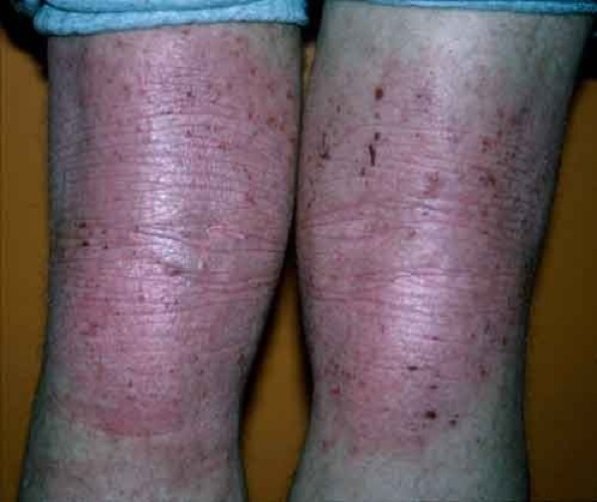 Backs of both knees showing thickened reddened skin with deep exaggerated skin creases and scattered small dark excoriated spots.