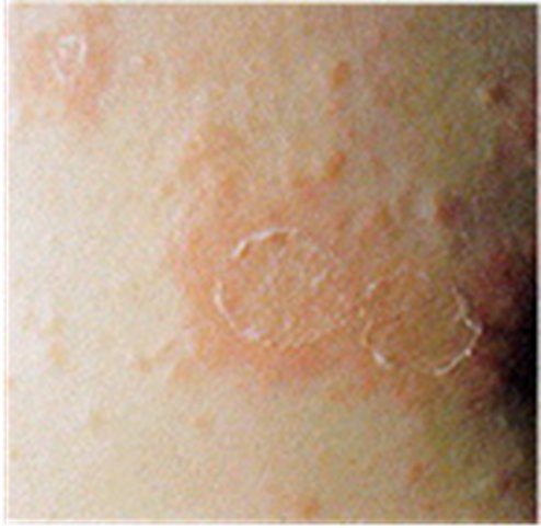 Pale skin with two ring-shaped lesions, each edged by a fine rim of scale that is attached at the outer margin and lifting free toward the center.