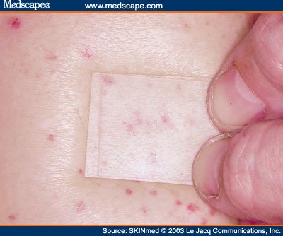 A clear glass slide pressed against skin by a thumb and finger; small red spots remain visible through the glass in the compressed area and continue outside it.