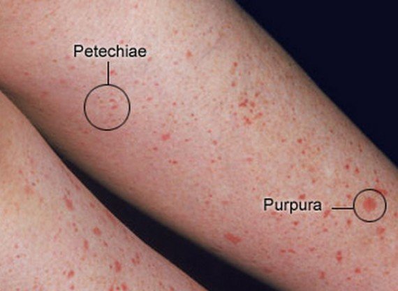 Lower leg scattered with small red spots, with two labeled circles marking a cluster of pinpoint spots as petechiae and a single larger spot as purpura.
