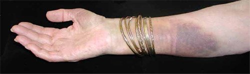Forearm with a large irregular purple-blue discolored area above the wrist, flat and blending into surrounding skin.