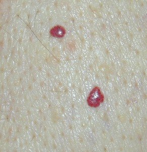 Close view of pale skin with two small bright red dome-shaped raised lesions, the larger one lobulated.