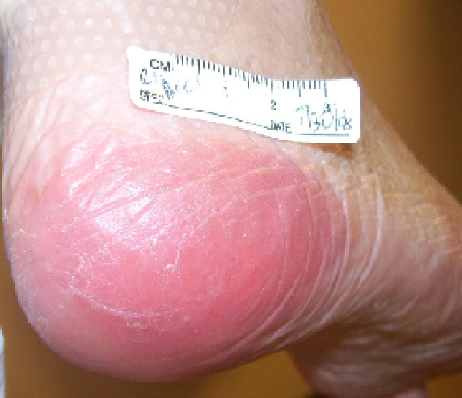Heel of a foot with a large well-defined pink-red area over the pressure point, the skin unbroken, with a paper measuring tape laid beside it.