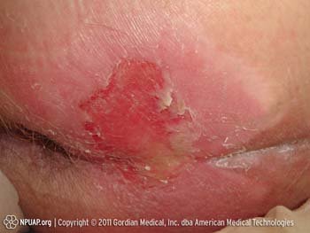 Reddened skin over a bony prominence with a shallow open wound at its center exposing a moist pink-red base.