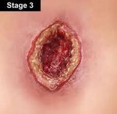 A deep crater-like open wound labeled Stage 3, with a dark red base, thickened yellow-tan margins and surrounding reddened skin.