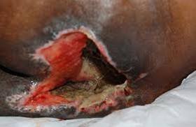 A large deep wound on darkly pigmented skin with an open red cavity, extensive yellow-gray necrotic tissue and undermined blackened edges.