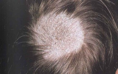Scalp with a well-defined round area of hair loss covered in fine gray scale, the remaining hairs within it short and broken.