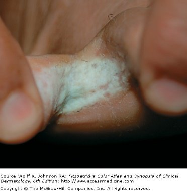 Two toes held apart showing white sodden macerated skin in the web space with fine scaling at the margins.